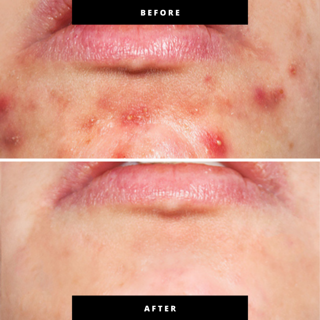 Rejuve Pro: 3-Minute New Age LED Pen